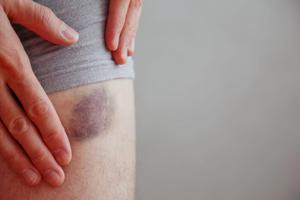 A person with a large bruise on their leg from a car crash.